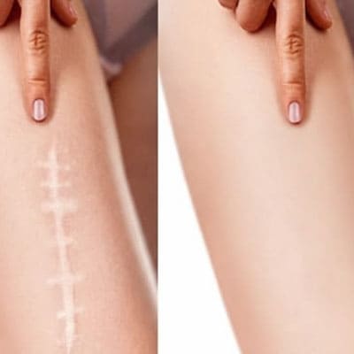 IN SURGICAL WOUND REPAIR