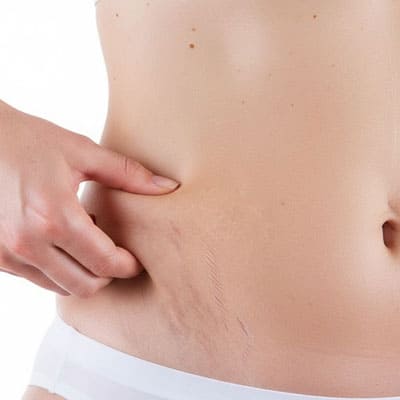 IN THE TREATMENT OF SKIN CRACKS