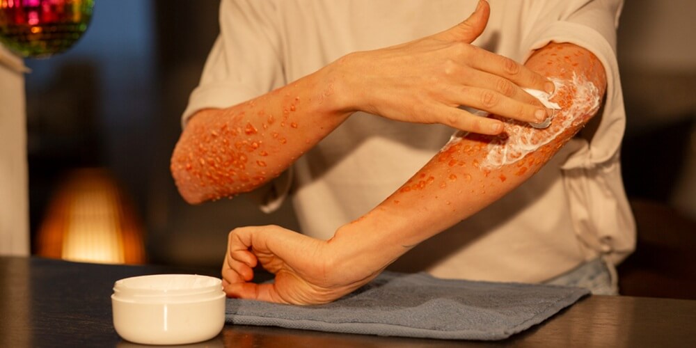 Burn Treatment Advances Using Stem Cells: Is there a treatment for burns using Zaren Stem Cell Therapy?