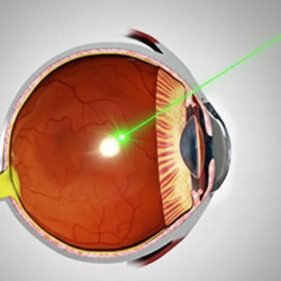 RETİNİS PIGMENTOSA (RP)