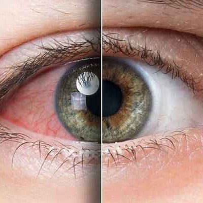 TRAUMATIC OPTIC NEUROPATHY (TON)