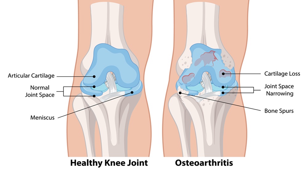 osteoarthritis-zaren-stem-cell-01