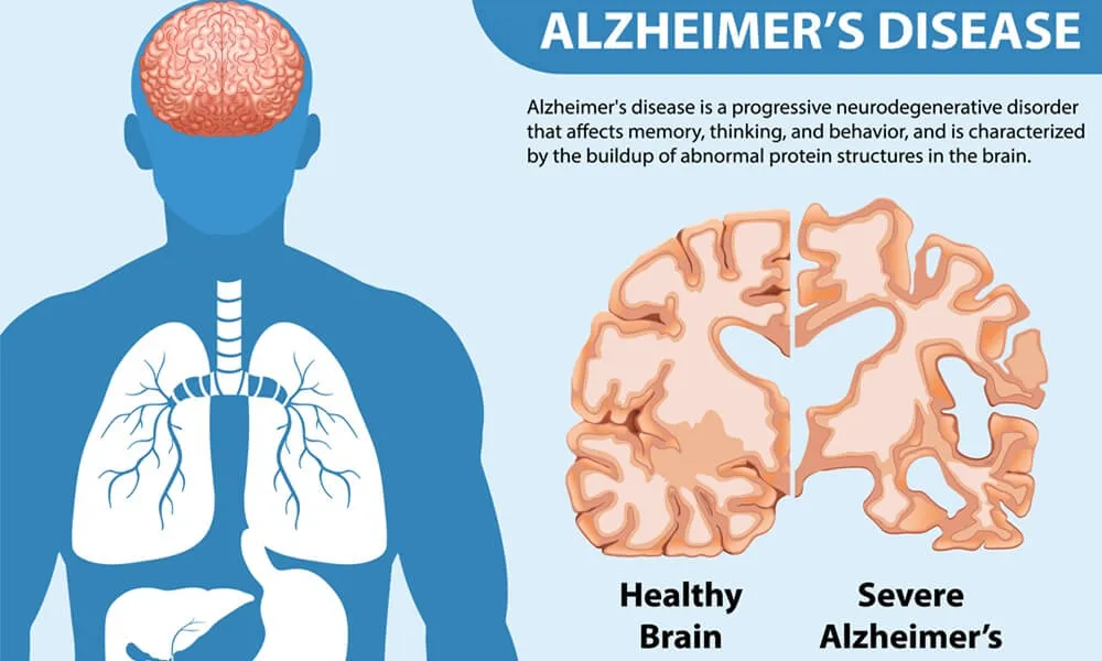 alzheimer-zaren-stem-cell-1