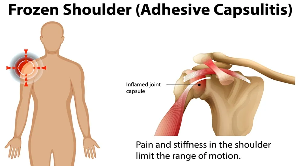 frozen shoulder