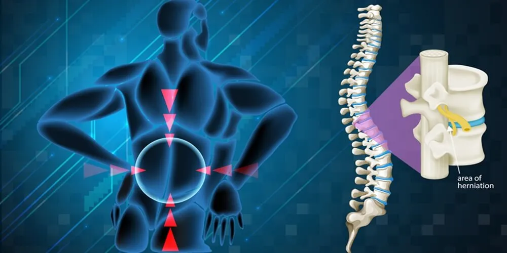  Intervertebral Disc Degeneration