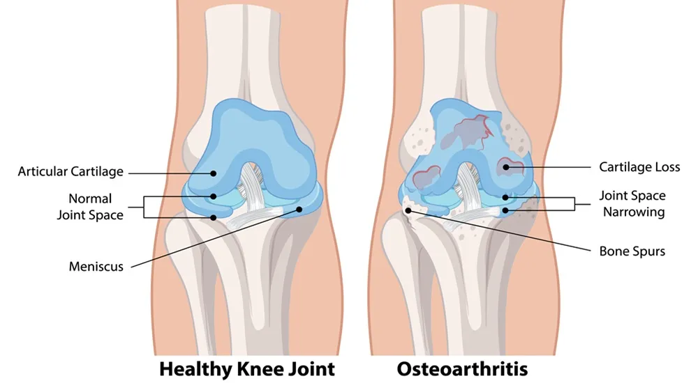osteoarthritis zaren stem cell