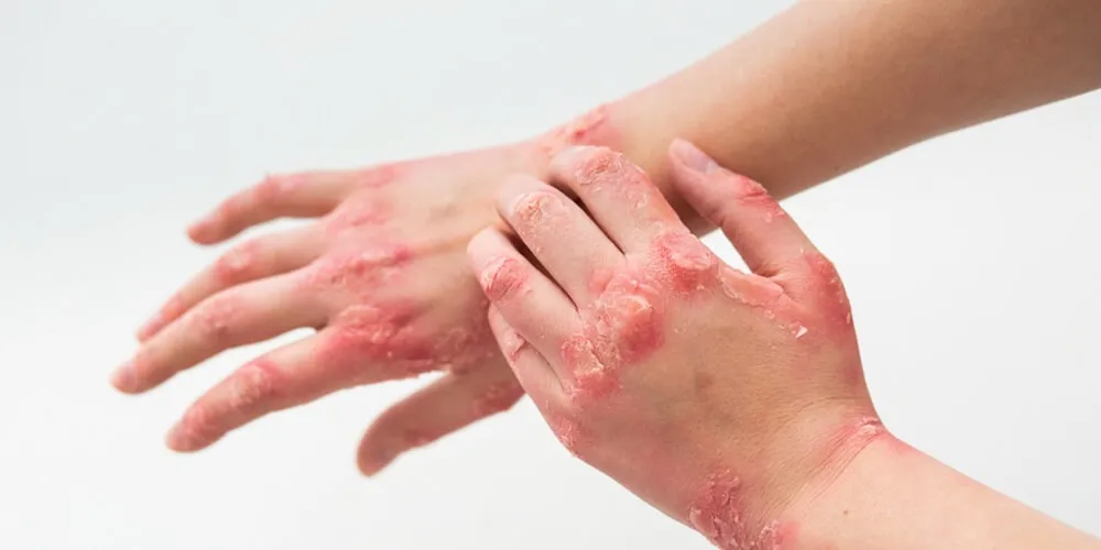 upus-disease-zaren-stemcell-01